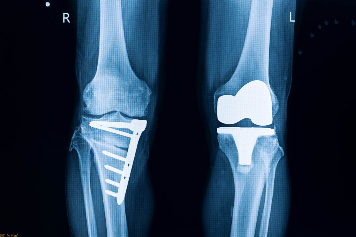 Exactech Knee Implant Recall Lawsuit Attorneys